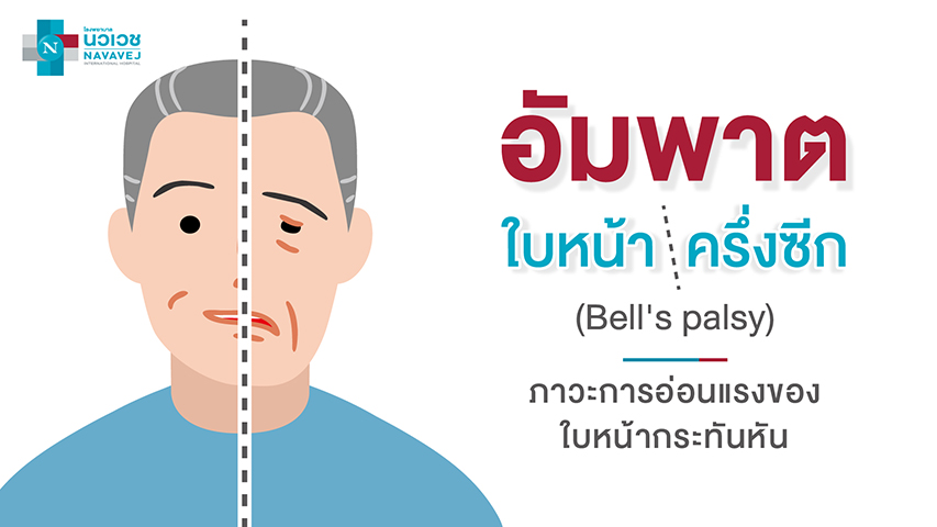 อัมพาตใบหน้าครึ่งซีก (Bell's Palsy)