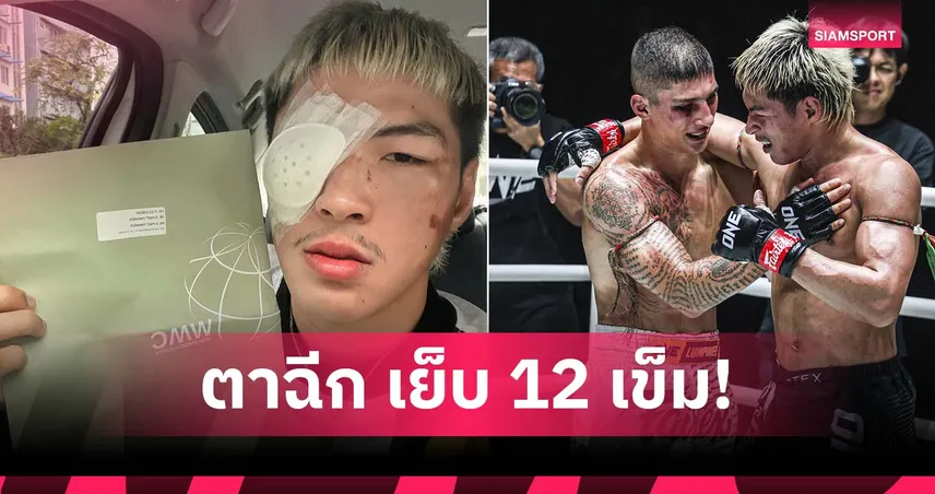 "ยอดไอคิว" ตาขาวฉีกเย็บ 12 เข็ม หลังไฟต์กัดฟันชนะ อาเลสสิโอ ONE ลุมพินี 117