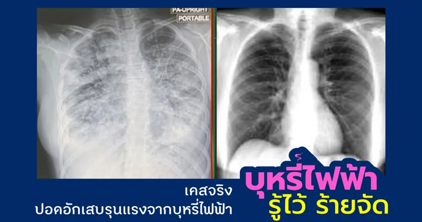 หากคุณคิดว่าสูบพอดไม่ร้าย ไม่อันตราย ลองฟังความจริงจากผู้ป่วยวัยรุ่นเหล่านี้คุณจะเปลี่ยนใจ