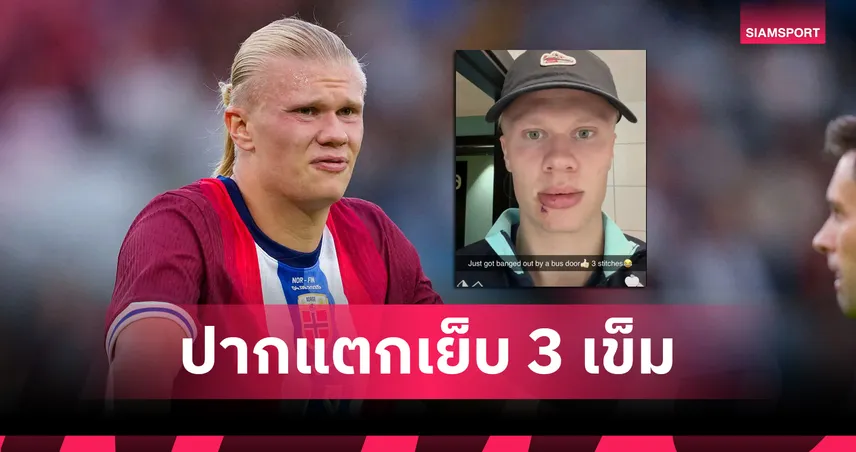 โดนฟาดปากแตก! ฮาลันด์ ช้ำเย็บ 3 เข็ม ระหว่างช่วยนอร์เวย์ คัดบอลโลก